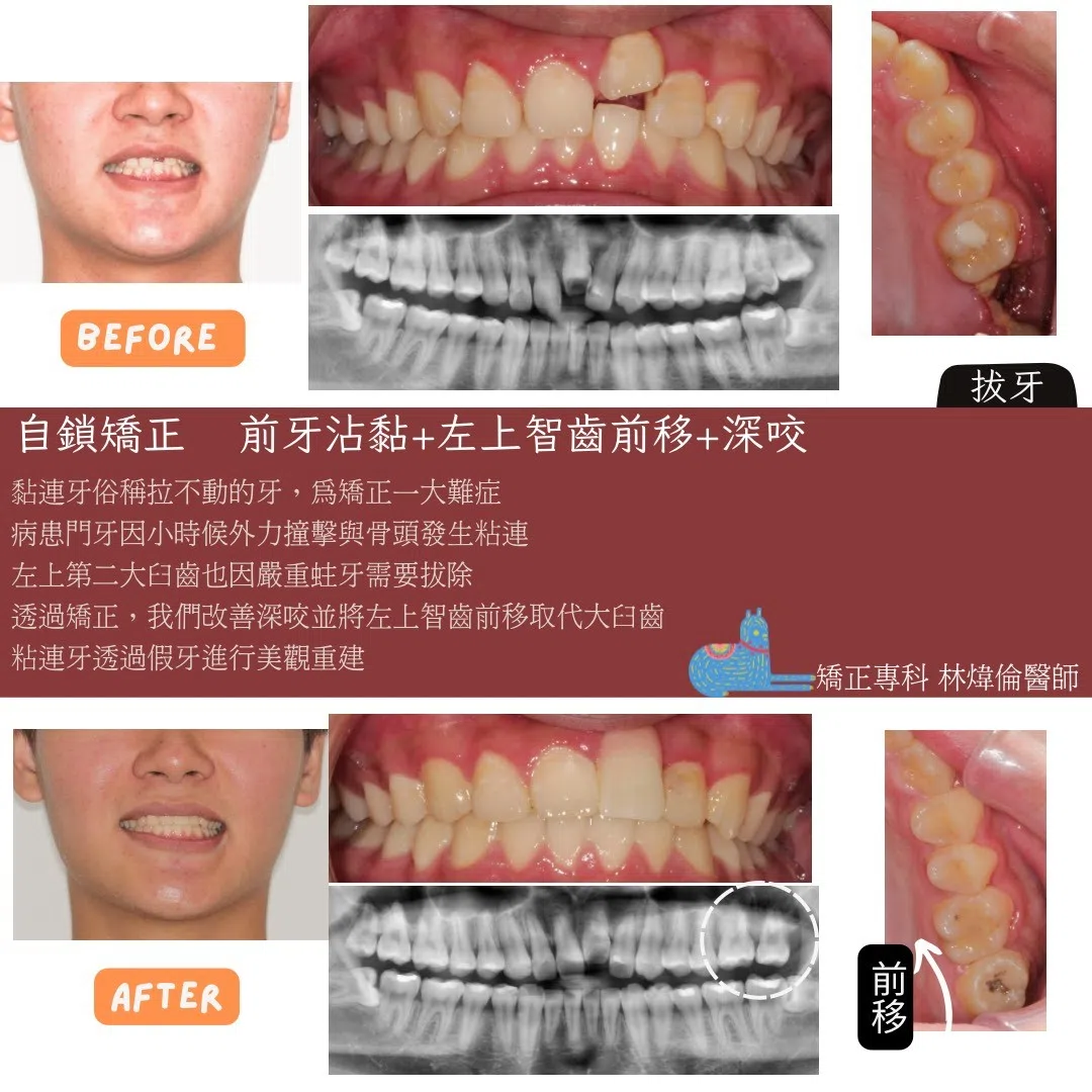 【門牙沾黏＋缺牙？矯正竟然一舉多得！】