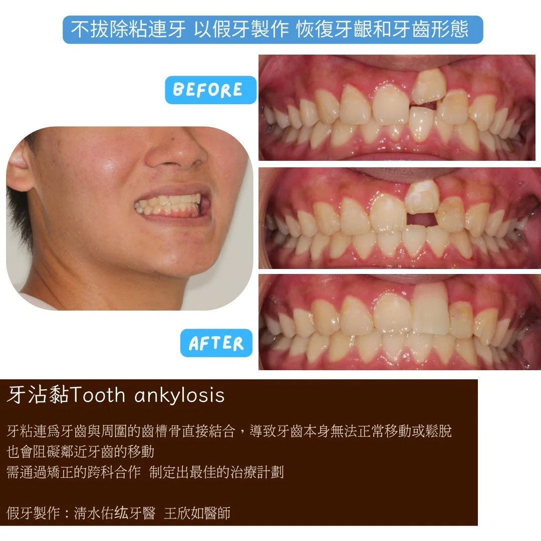 【門牙沾黏＋缺牙？矯正竟然一舉多得！】