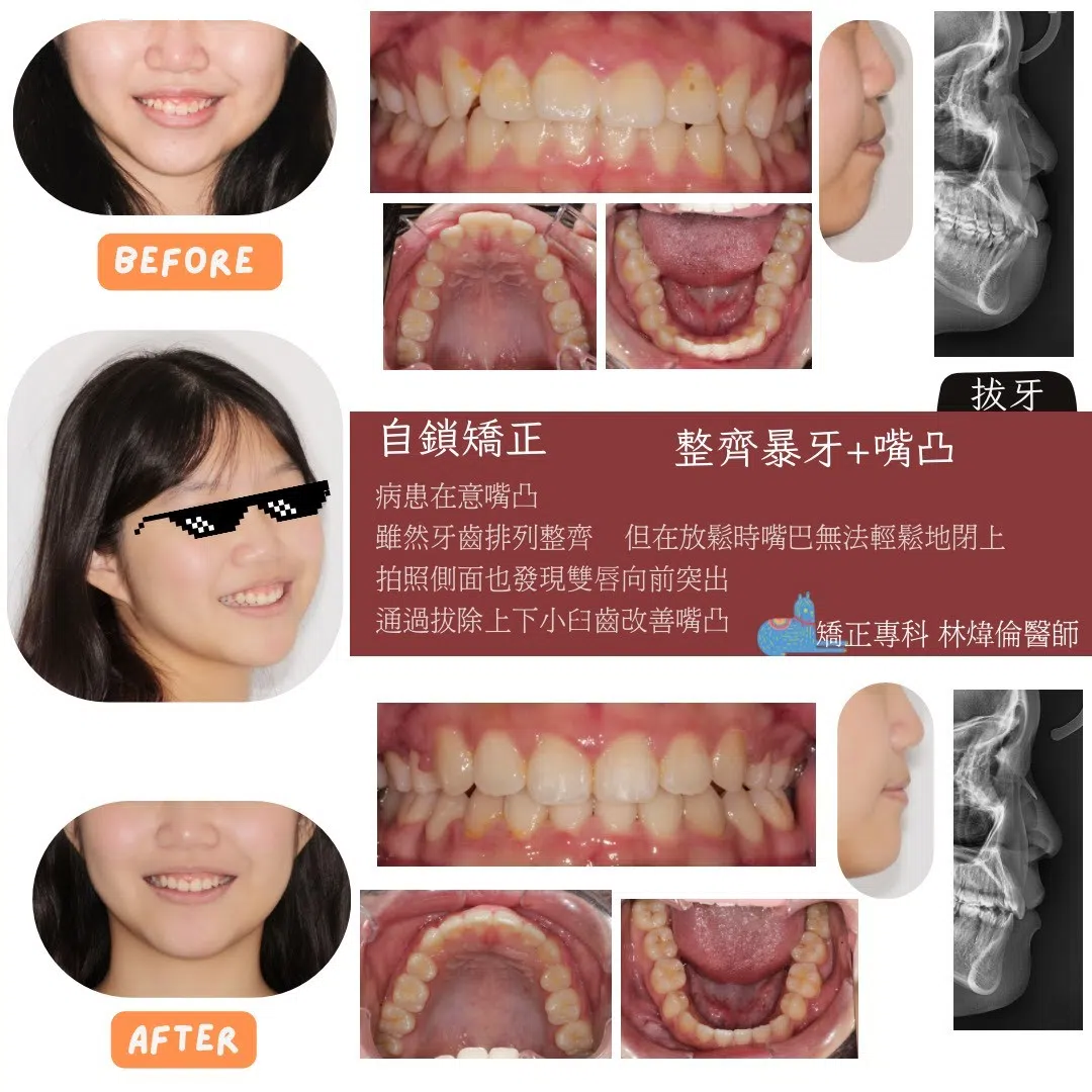 【牙齒很整齊，為什麼側臉還是凸凸的？】