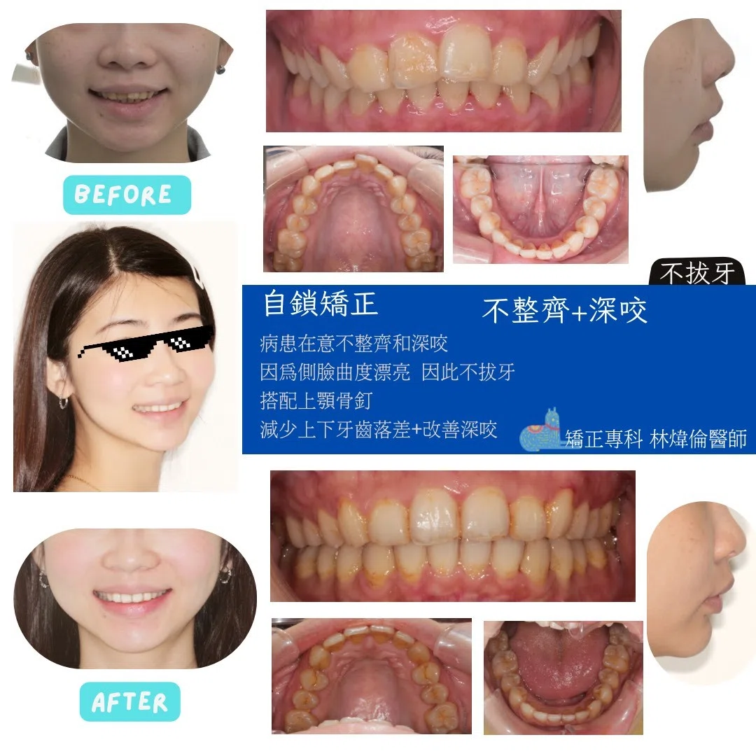 【深咬＋牙齒不整齊，但側臉明明很好看！】