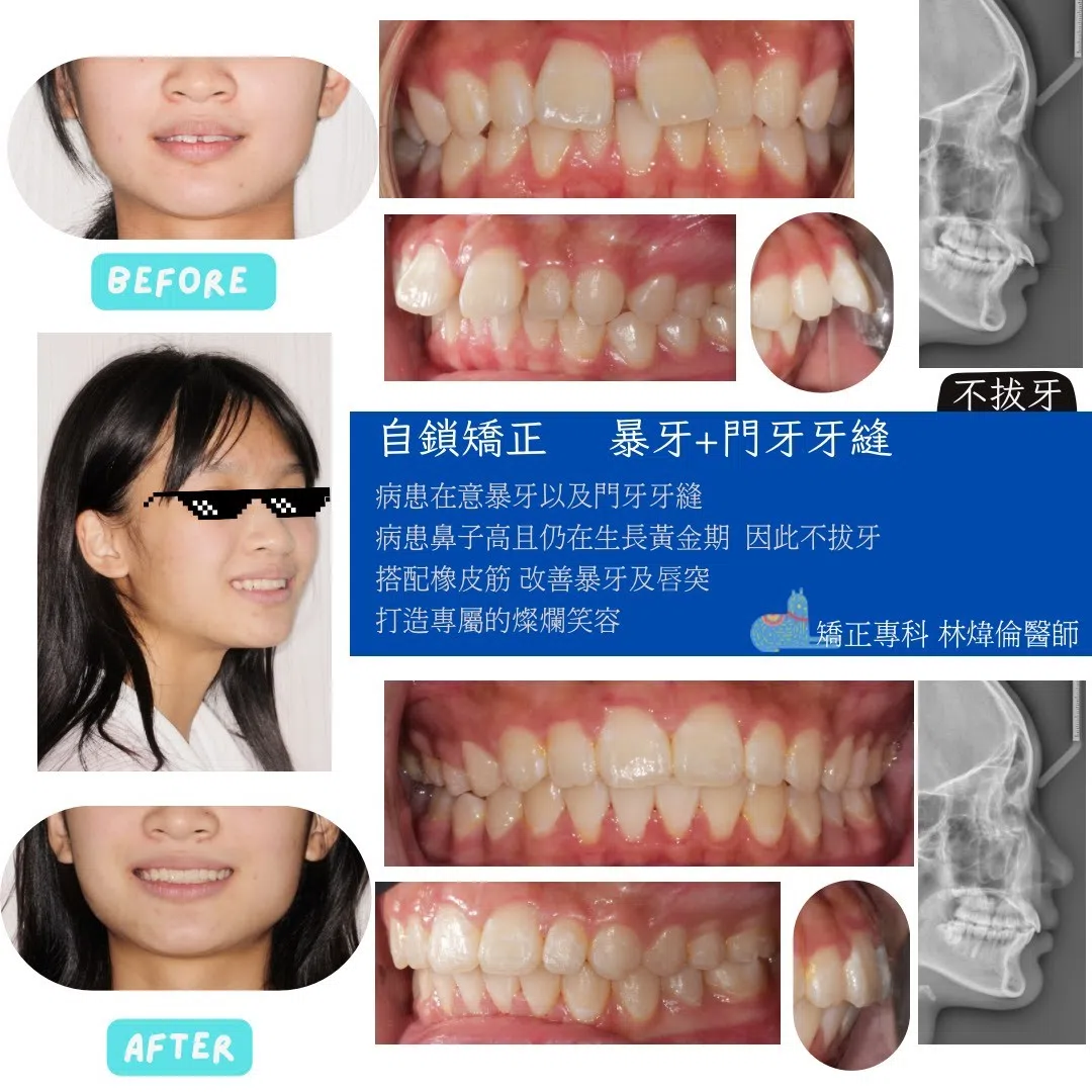 🦷【生長期矯正＋不拔牙，一次改善暴牙和門牙縫！】