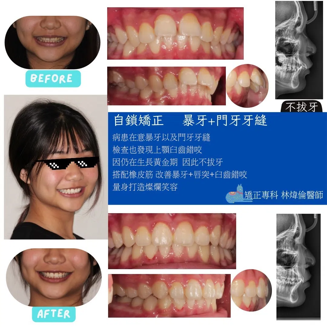 🦷【生長期矯正＋不拔牙，一次處理多個問題！】