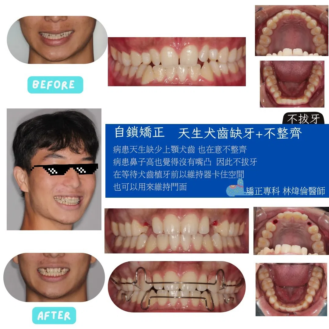 🦷【天生缺虎牙，也能先把笑容顧好】