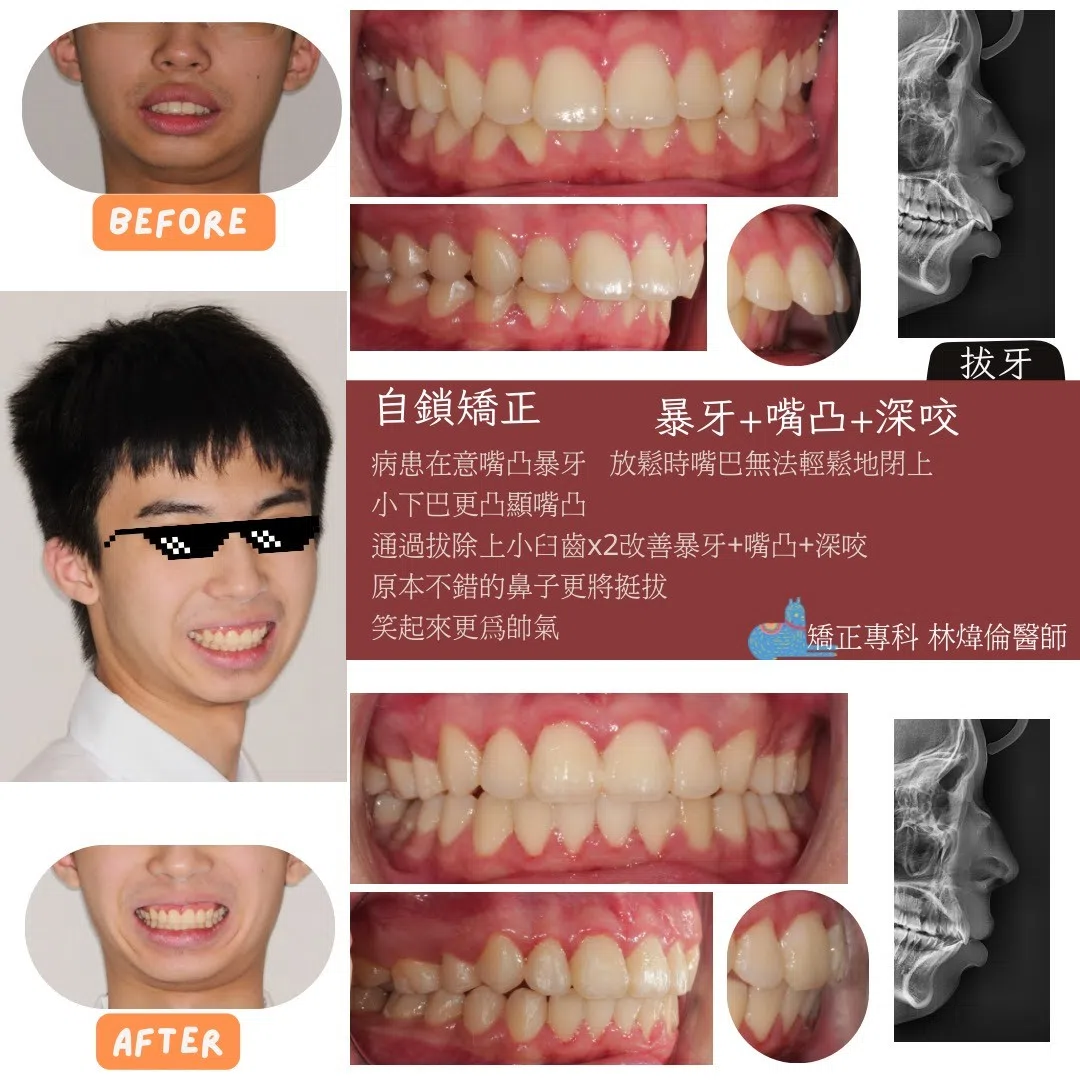 🦷【暴牙＋嘴凸＋深咬，矯正後整個人都不一樣了】