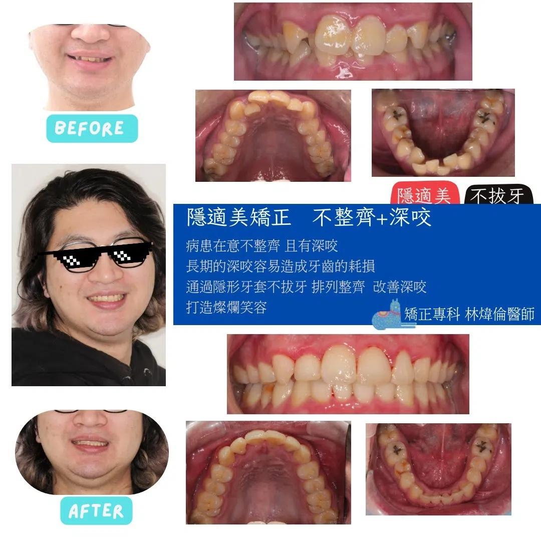 🦷【深咬又不整齊，用隱適美也能改善！】