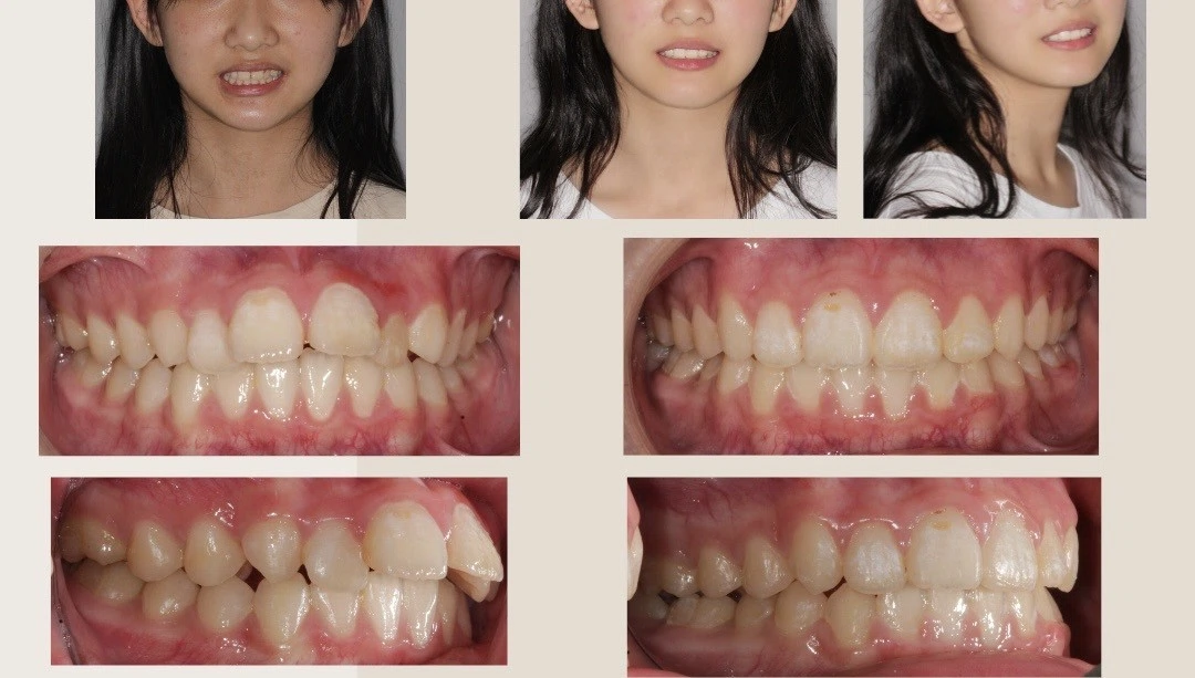 【不拔牙,也能改善暴牙】 【不拔牙,也能改善暴牙】