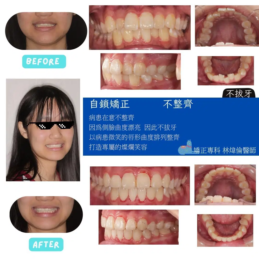 🦷【牙齒很擠，但臉型其實很好看！】