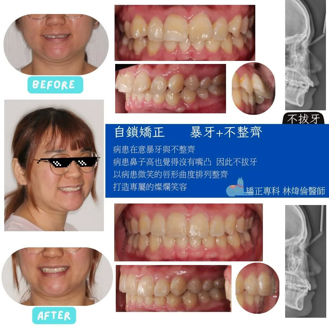 🦷【醫師覺得拔牙會更美,病人卻說:我喜歡現在的臉型!】 🦷【醫師覺得拔牙會更美,病人卻說:我喜歡現在的臉型!】